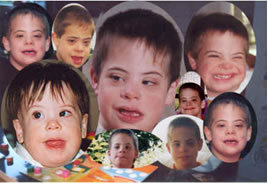 Açıklama: Down sendromu