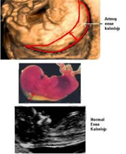 Açıklama: Fetal ense kalınlığı