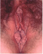 Açıklama: Genital Siğiller