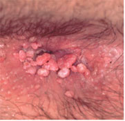 Açıklama: Genital Siğil